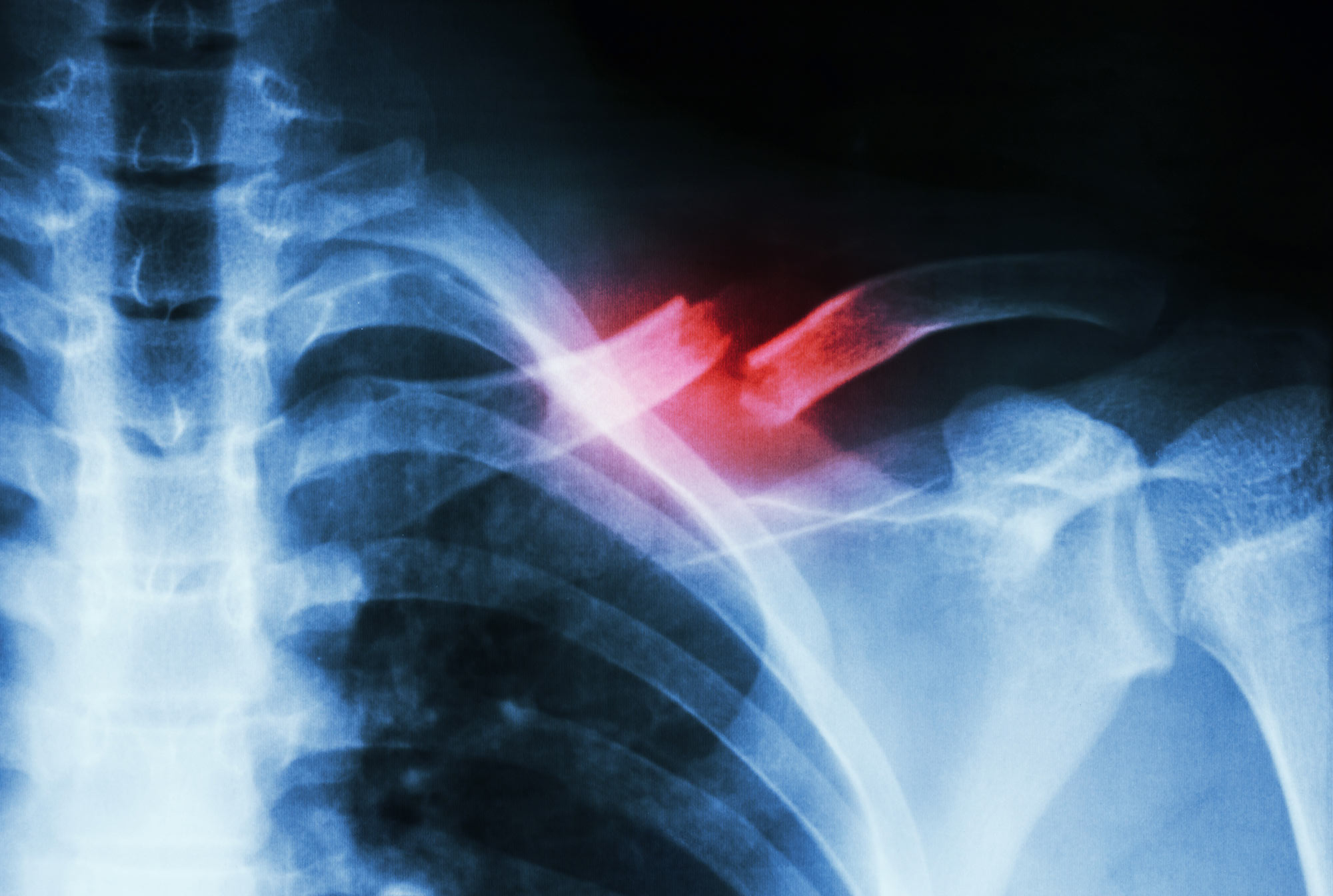 Broken collarbone